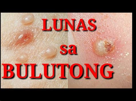 bulutong